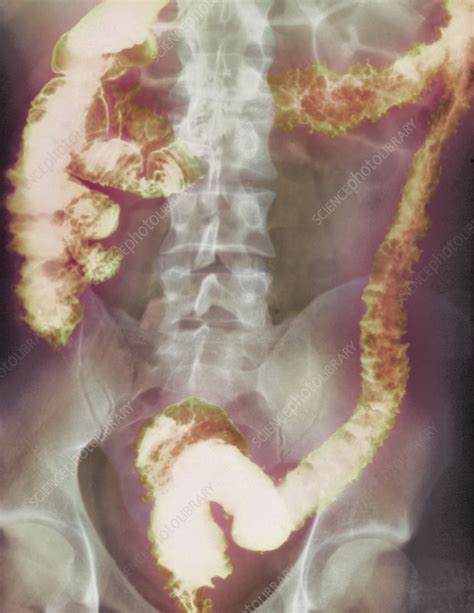 Crohns Disease X Ray Stock Image M1300647 Science Photo Library