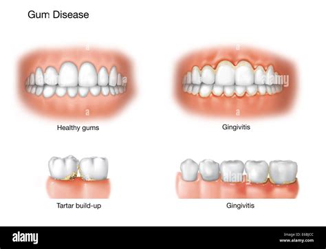 Comparison Of Healthy Gums Versus Gingivitis Stock Photo Alamy