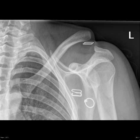 Acromioclavicular Joint Dislocation Image Radiopaedia Org