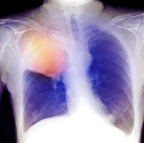 Lung Cancer X Ray Photograph By Du Cane Medical Imaging Ltd Pixels