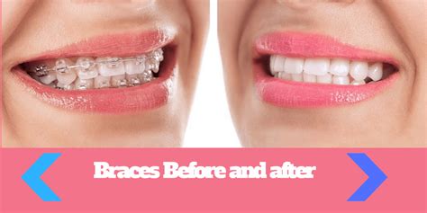 Find Out Braces Before And After Pictures Results For Adults