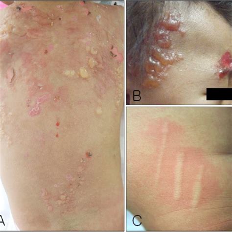 A Sub Epidermal Bullae With A Dense Cellular Infiltration In The