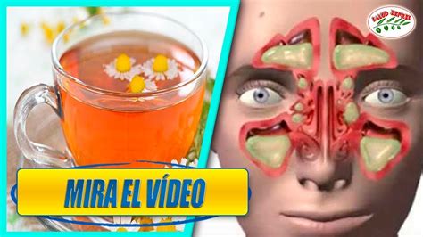 Los 5 Mejores Remedios Para Aliviar La Sinusitis Youtube