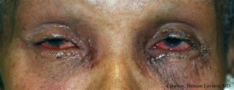Bilateral Keratoconjunctivitis American Academy Of Ophthalmology