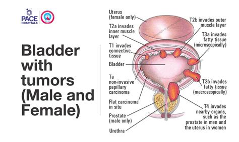 Transurethral Resection Of Bladder Tumour Turbt