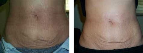 Stretch Mark Laser Removal Cosmetic Laser Institute