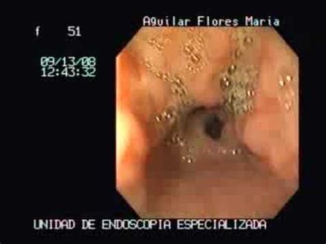 We did not find results for: erosive gastritis - YouTube