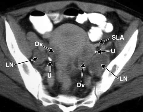 Recognition Of The Ovaries And Ovarian Origin Of Pelvic Masses With Ct
