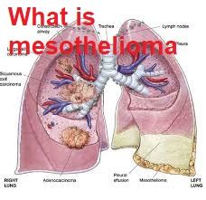 We did not find results for: What is Mesothelioma? - #112 ASIAN GARLIC NOODLES - DON'T ...