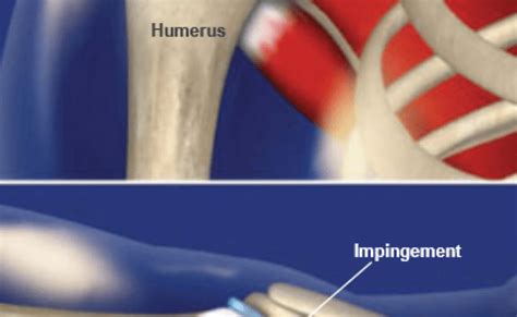 Six Causes Of Shoulder Impingement Syndrome Part 2 Otosection