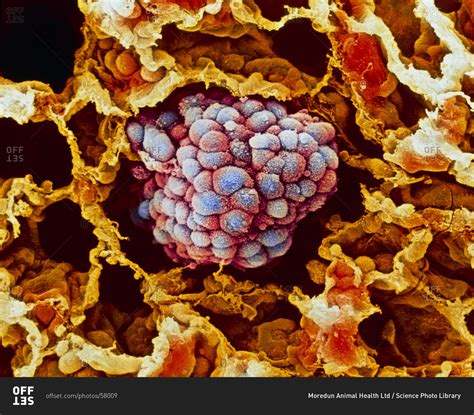 While smoking is its top cause, lung cancer can strike those who have never touched a cigarette. Magnification view of Lung cancer under a color scanning ...