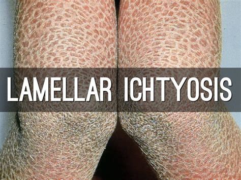 Lamellar Ichtyosis By Milk 2