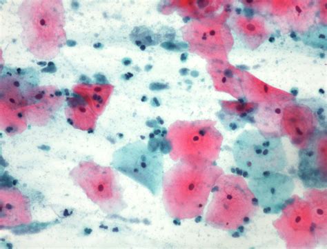 Conventional Smear Trichomonas Infection Papanicolaou Stain ×200