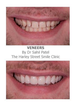 One of the handiest techniques is orthodontics. Veneers for Gaps In Teeth | Harley Street Smile Clinic