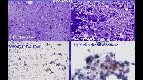 Introduction To Fna Cytopathology Youtube