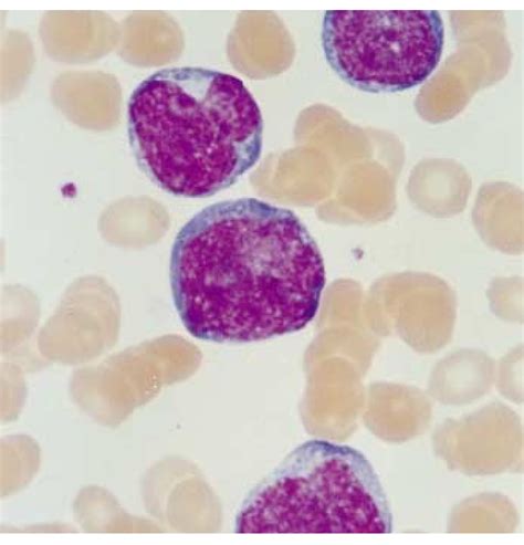 Peripheral Blood Smear In Leukemic Mantle Cell Lymphoma Blastoid