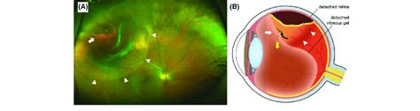 Pathogenesis Of Rhegmatogenous Retinal Detachment Rd A Wide Field