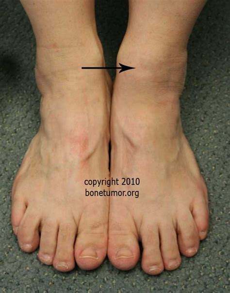 Runners Bump Foot And Ankle