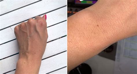 Internet Left Baffled As Women Share Photos Of Identical Freckles On Their Hands Heart