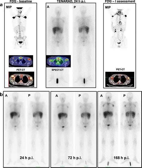Petct Scans Of 15 Responding Hodgkins Lymphoma Patients Treated With