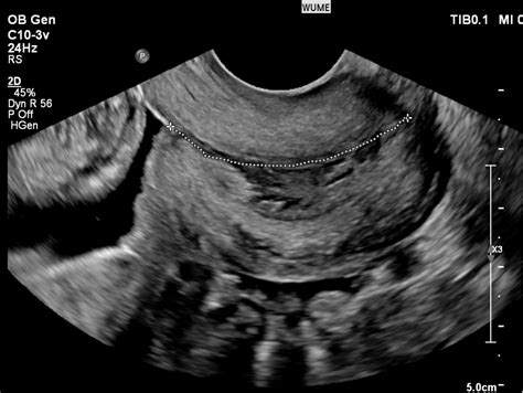 Ultrasound In Pregnancy Women S Ultrasound Melbourne