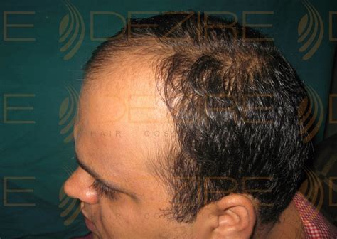 Hair Restoration Doctor In India Hair Transplant Pune