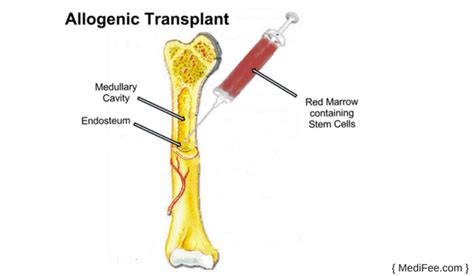 Bone Marrow Transplant Treatment Options And Risks