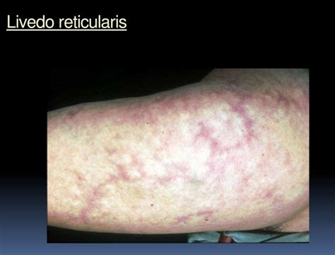 Livedo Reticularis Mottling Skin Causes Pictures Treatment