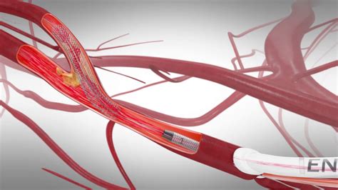Tcar Transcarotid Arterial Revascularization Youtube