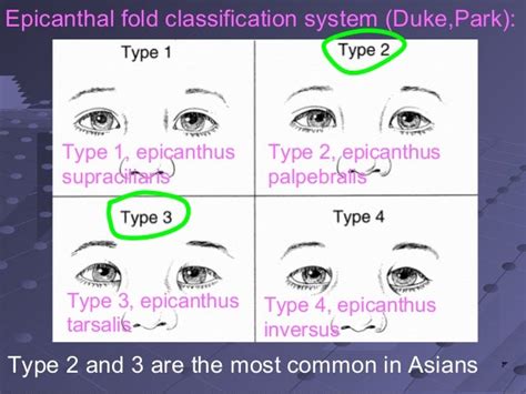 Epicanthic Fold Types