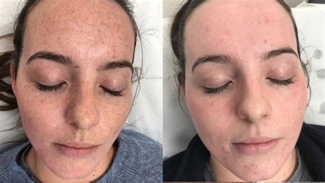 Freckle Removal Before And After Using Picosure Laser Located In The City Of London Ec3m 1eb