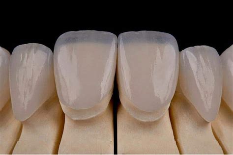 Ceramic Laminate Veneer Dental Clinics Turkey