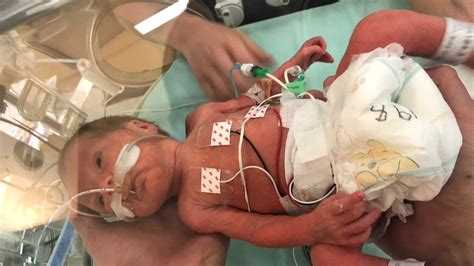 When Premature Birth Leaves Mother And Baby In Neonatal Unit Far From