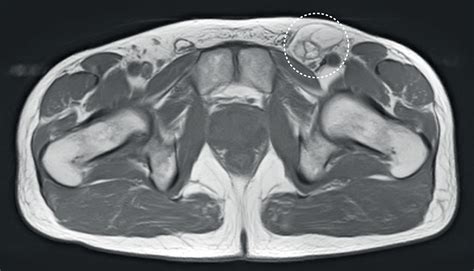 A Recurrent Lump In The Groin Poses A Diagnostic Problem The Lancet