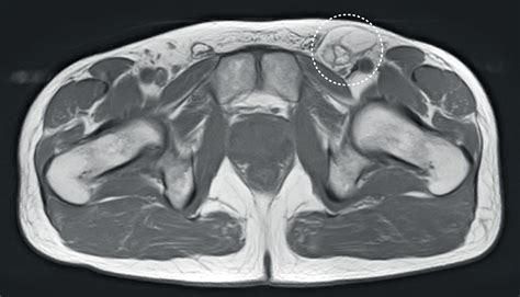 There's not many, maybe 3 or 4 at a time. A recurrent lump in the groin poses a diagnostic problem ...