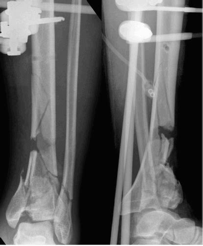 Full Article External Fixation Of Tibial Pilon Fractures And Fracture