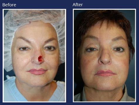 Cancer Defect Reconstruction Holzapfel Lied Plastic Surgery