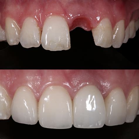 Missing Teeth And Partial Dentures Afam Dental