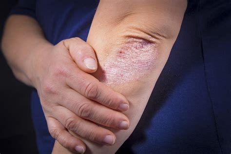 Mild Psoriasis On Elbow Psoriasis Cure Now