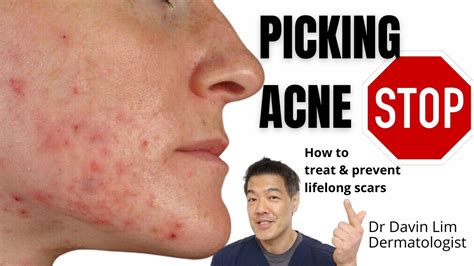 Picking Acne How To Treat To Prevent Lifelong Scars Youtube