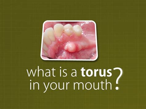 Torus An Out Growth Of The Bone It Usually Develops On The Roof Of