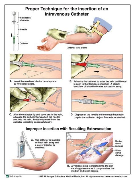 Iv Therapy Tips And Tricks How To Hit The Vein In One Shot