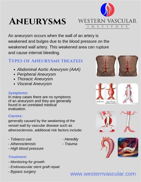 Aneurysms Vascular Surgery Medical Knowledge Medical School Essentials
