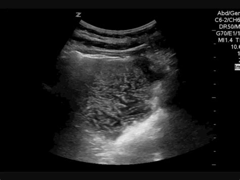 Pocus Dilated Stomach With Pulsating Gastric Contents Grepmed