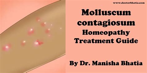 Molluscum Contagiosum Doctor Bhatias Asha Homeopathy