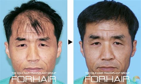 Video call you can schedule a video call with a knowledgeable consultant from anywhere. FORHAIR Hair Transplant Group Korea - Hair Transplant ...