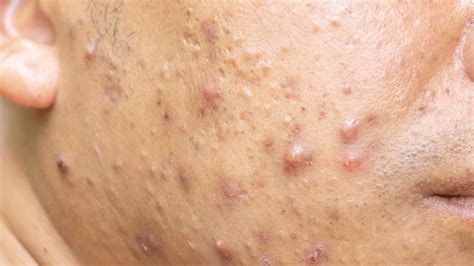 Types Of Acne Cystic Acne Gladskin
