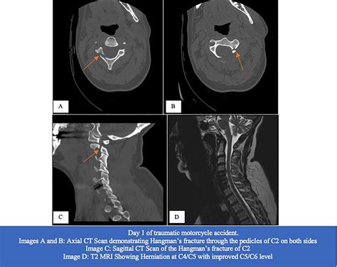 Traumatic Hangmans Fracture After Cervical Disk Arthroplasty With