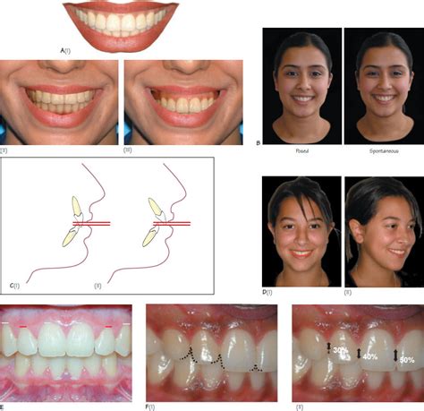 17 Smile Analysis Pocket Dentistry