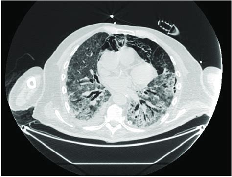 Ct Chest Transverse View Of A Pneumomediastinum In A 78 Year Old Male